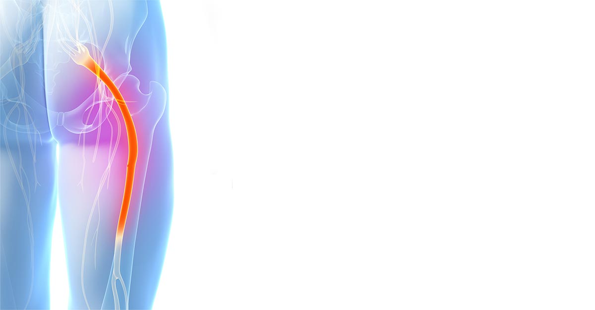 Hauppauge, Long Island sciatica treatment and chiropractic