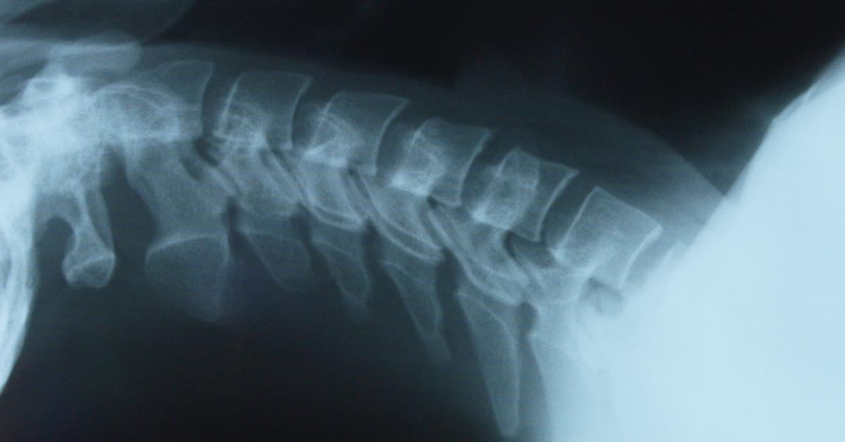 Hauppauge, Long Island Back Pain Treatment without Surgery